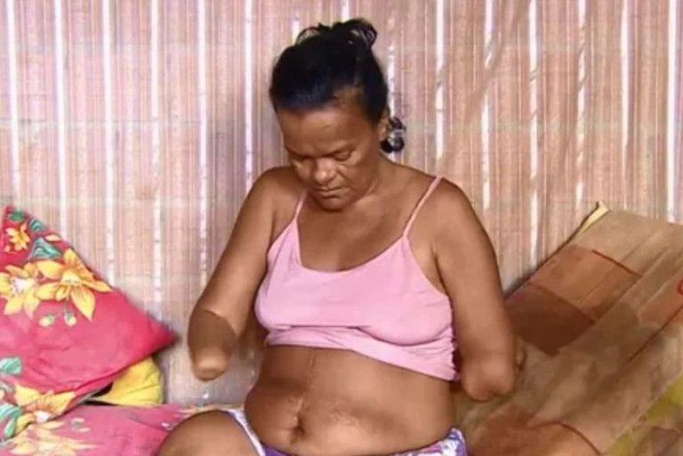 Mulher sem mãos e pernas tem pedido de benefício negado pelo INSS por não poder assinar papel