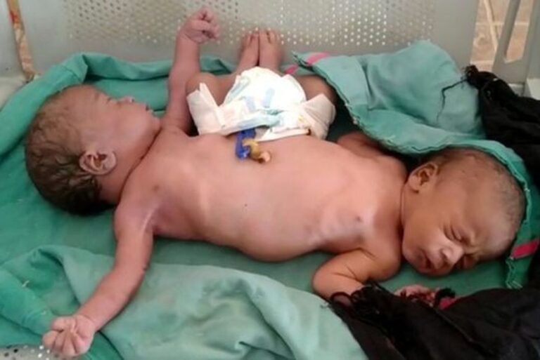 Gêmeas siamesas nascem com duas pernas e quatro braços e desafiam médicos Gêmeas siamesas nascem com duas pernas e quatro braços e desafiam médicos