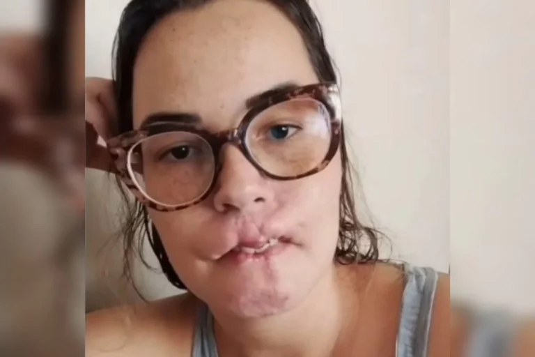 Mulher que perdeu lábios após preenchimento desabafa: “Fui enganada”