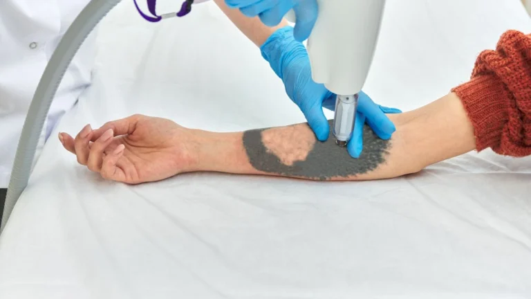 Remoção de tatuagem com laser: como funciona?