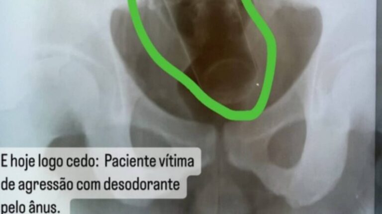 EM INGÁ: Médico é demitido por vazar raio-x de paciente com desodorante no ânus
