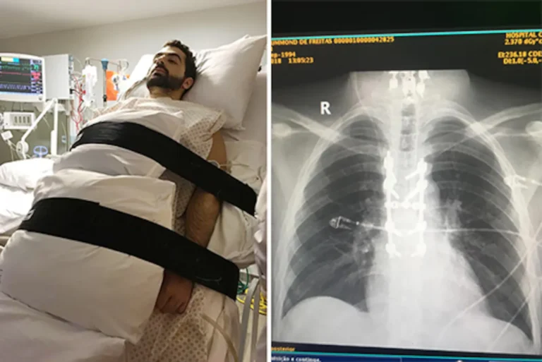 Anvisa libera pesquisa clínica da polilaminina, substância que pode regenerar lesão medular